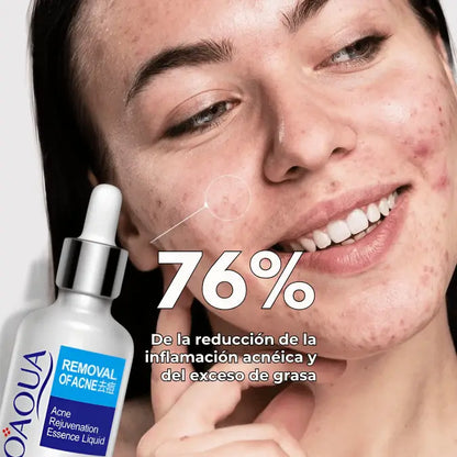 Sérum removedor de acné - Bioaqua